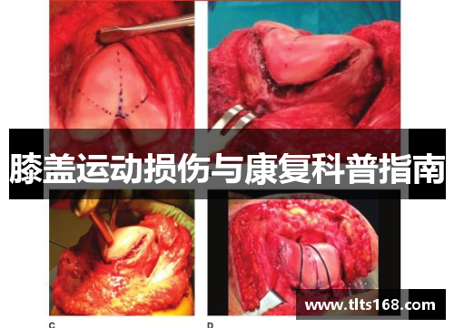膝盖运动损伤与康复科普指南
